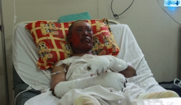 Nổ lò luyện thép, hai công nhân bị bỏng nặng