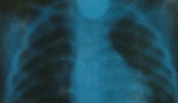 Bé gái 3 tuổi nuốt đồng xu bị mắc kẹt trong họng