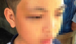 Thầy giáo dùng gậy tre vụt tím mắt học sinh