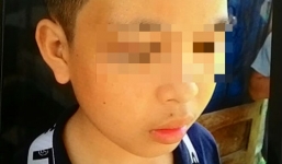 Thầy giáo dùng gậy tre đánh học sinh bầm mắt