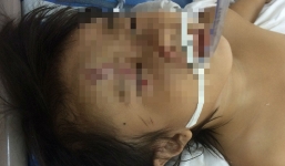 Rơi qua lỗ thông gió tầng 1, bé gái 4 tuổi chấn thương sọ não