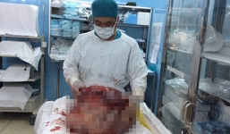 Cắt bỏ thành công khối u nặng 26 kg trong bụng người phụ nữ