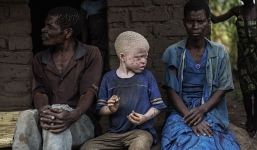 Sốc trước nạn “săn” người bạch tạng lấy nội tạng tại Malawi