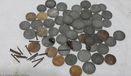  Phẫu thuật gắp 140 đồng xu và 150 chiếc đinh nhọn ra khỏi dạ dày người đàn ông