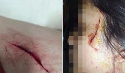 Điều tra Facebook thời trang tung tin cô gái bị rạch mặt