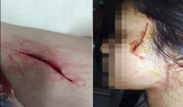 Thực hư tin đồn cô gái bị cướp rạch mặt ngay giữa Hà Nội