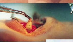 Hãi hùng chứng kiến cảnh gắp 15 con dòi ra khỏi chân răng của bé gái