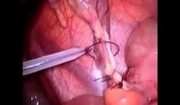 Mục sở thị một ca phẫu thuật nội soi cắt ruột thừa