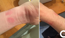 Đeo Apple Watch, người dùng bị dị ứng