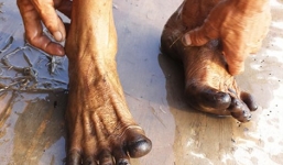 Hiện tượng lạ: Chân bị đen thui sau khi lội ruộng