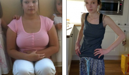 Cô gái xinh đẹp hóa “bộ xương di động” sau khi uống thuốc giảm cân