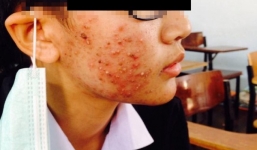 Kinh hoàng nam sinh bị hủy hoại gương mặt vì mỹ phẩm trôi nổi