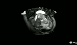 Clip: Cặp song sinh đá nhau, giành chỗ trong bụng mẹ