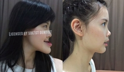 Ca 'dao kéo' thành công đến khó tin của cô gái hàm lệch “quái dị”