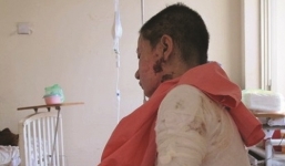 Trên đường đi làm về, cô gái xinh đẹp bị tạt axit