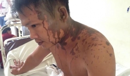 Xông vào nhà tạt axit chém loạn xạ, côn đồ rớt 3 ngón tay ở hiện trường