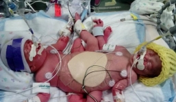 Kỳ lạ ca sinh ba có 2 bé dính liền nhau vẫn sống sót thần kỳ