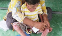 Sự thật tin đồn về cô bé bị cha mẹ tạt nước sôi, lở loét khắp người