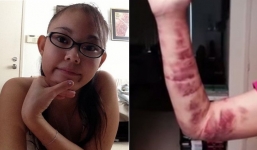 Mắc bệnh lạ cô gái chảy máu từ mắt và miệng không thể kiểm soát