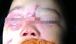 Bé 3 tuổi bị chó nhà cắn rách tai, giác mạc và dây chằng