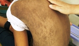 Nữ sinh 13 tuổi mắc 'bệnh lạ' toàn thân đen sạm như da trâu