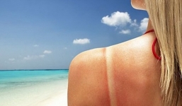 Chăm sóc da cháy nắng với 17 nguyên liệu tự nhiên một cách hiệu quả