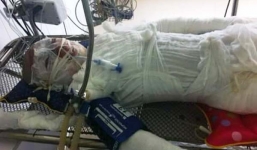 4 học sinh bị điện cao thế phóng cháy người