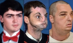 Video: Cuộc gặp xúc động giữa người đàn ông ghép mặt và em gái ân nhân