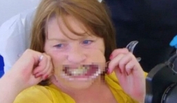 Người phụ nữ dùng keo để dính răng vào lợi suốt 10 năm