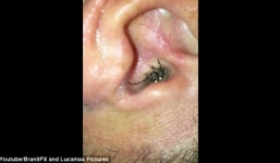 Hoảng hồn phát hiện nhện làm tổ trong… tai người