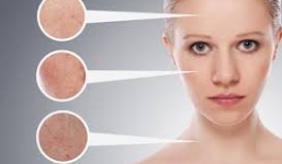 Cách trị mụn đầu đen tận gốc cực hiệu quả và an toàn