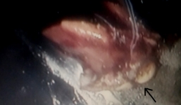 Ăn khuya vội vàng, cụ ông nuốt luôn cả hàm răng giả