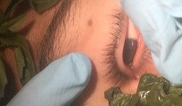 Kinh hãi phát hiện con sâu dài 3 cm 'làm tổ' trong mắt 