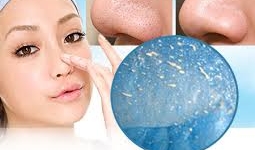 Cách trị mụn đầu đen ở mũi cực đơn giản mà hiệu quả