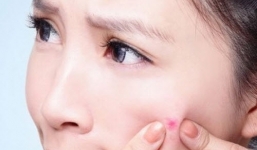 Cách trị mụn thâm nhanh nhất và an toàn tại nhà