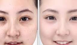 Cách trị mụn thâm hiệu quả và đơn giản cho phụ nữ