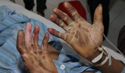 Hà Nội: Hai người nguy kịch vì ăn tiết canh