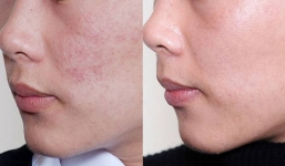 Cách trị mụn thâm ở mặt cực nhanh và an toàn