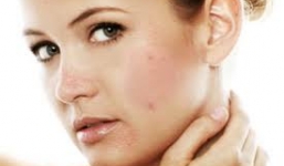 Cách trị mụn bọc cấp tốc cực hay và hiệu quả cho phụ nữ