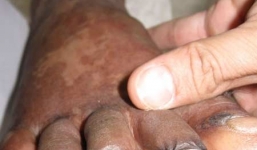 Tử vong vì ăn tiết canh