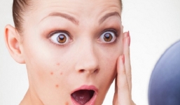 Cách trị mụn trứng cá tại nhà cực hiệu quả và đơn giản