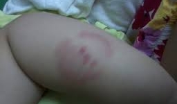 Bênh bạn gái, nam sinh bị bạn cắn vào vùng nhạy cảm