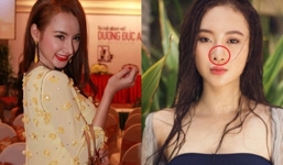 Chiếc mũi 'biến dạng' do phẫu thuật thẩm mỹ của Angela Phương Trinh