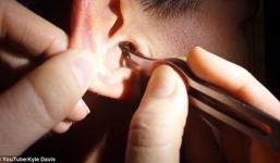 Video: Lấy cục ráy bằng cây nến nhỏ ra khỏi tai