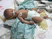 Bé trai 2 tháng tuổi bị cha đẻ đánh bầm tím, trật khớp chân