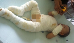 Bé trai 6 tuổi bị bố mẹ trói rồi đổ nước sôi lên người 