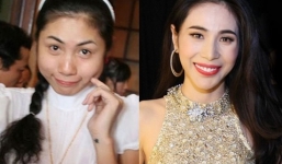 Thuỷ Tiên bỗng biến chứng độn cằm, béo gầy 'phập phù' vì tiêm botox?