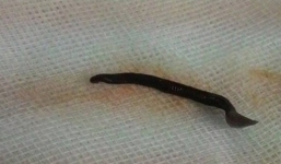 Video: Nội soi gắp đỉa dài 4,5 cm ra khỏi mũi bệnh nhân