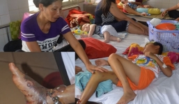 Bé trai 9 tuổi bị rắn lục đuôi đỏ cắn