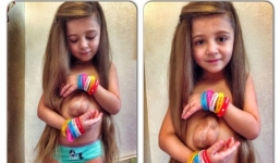 Kỳ lạ, bé gái xinh đẹp có trái tim nằm ngoài lồng ngực